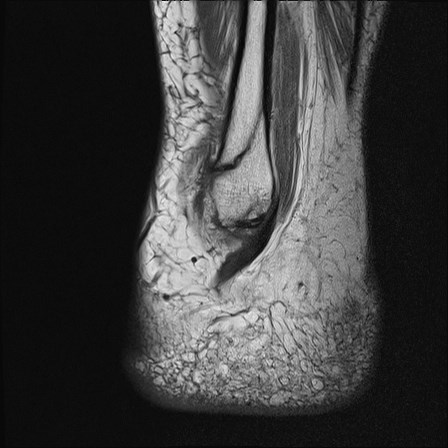 File:Anterior talofibular ligament injury - rupture with soft-tissue impingement (Radiopaedia 38765-40928 Sagittal PD 18).jpg