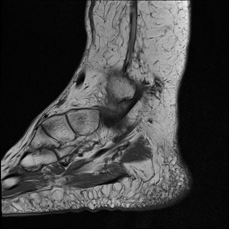 File:Anterior talofibular ligament injury - rupture with soft-tissue impingement (Radiopaedia 38765-40928 Sagittal PD 3).jpg