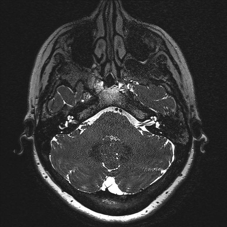 Anterior temporal encephalocele (Radiopaedia 82624-96808 Axial T2 high res 10).jpg