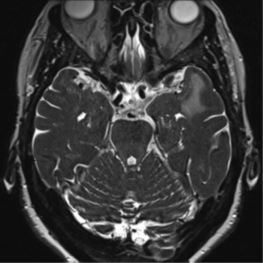 Anterior temporal pole cysts (Radiopaedia 46629-51102 Axial 38).png