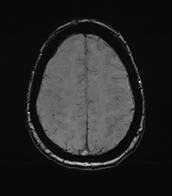 Anterior temporal pole cysts (Radiopaedia 46629-51102 Axial SWI 67).png