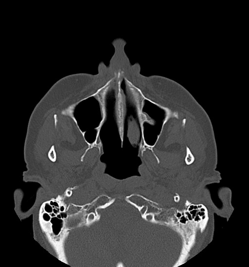 Anterior temporomandibular joint dislocation (Radiopaedia 59430-66784 Axial non-contrast 21).jpg