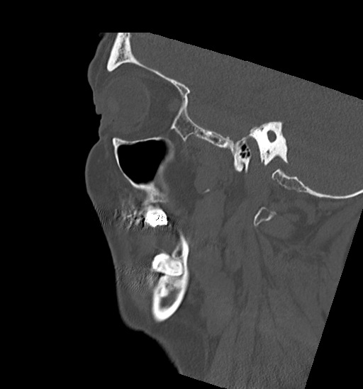 Anterior temporomandibular joint dislocation (Radiopaedia 59430-66784 B 47).jpg