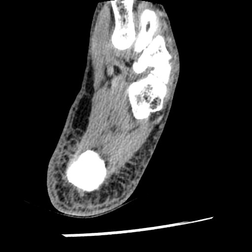 Anterior tibial artery false aneurysm (Radiopaedia 88984-105809 A 215).jpg