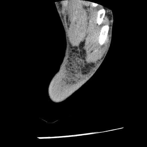 Anterior tibial artery false aneurysm (Radiopaedia 88984-105809 A 254).jpg