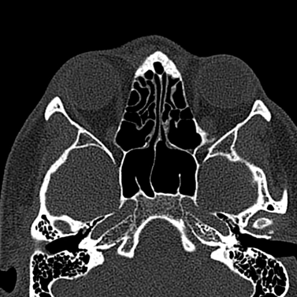 Antrochoanal polyp (Radiopaedia 30002-30554 Axial bone window 37).jpg