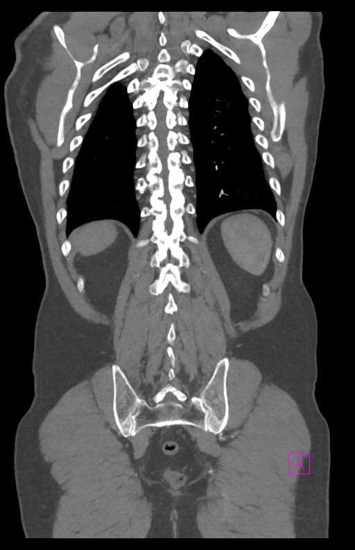 Aortectomy and axillary-bifemoral bypass (Radiopaedia 28303-28545 C 74).jpg