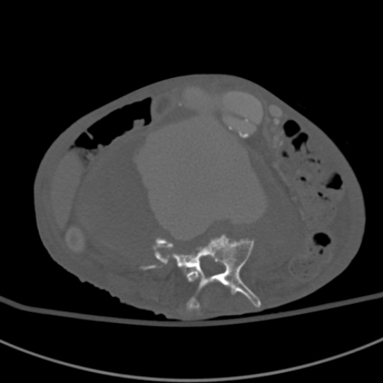 Aortic aneurysm with spinal destruction (Radiopaedia 42301-45410 Axial bone window 52).jpg