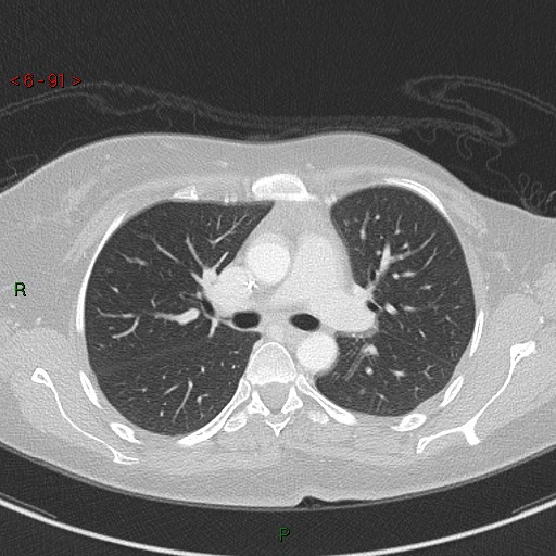 Aortic arch origin of left vertebral artery (Radiopaedia 51520-57286 Axial lung window 91).jpg