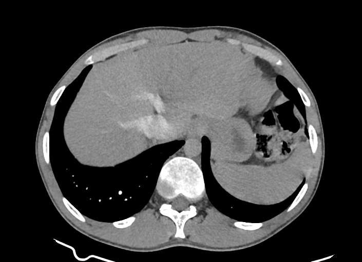 File:Aortic coarctation with aneurysm (Radiopaedia 74818-85828 A 46).jpg