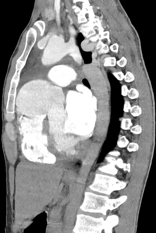 Aortic coarctation with aneurysm (Radiopaedia 74818-85828 B 91).jpg