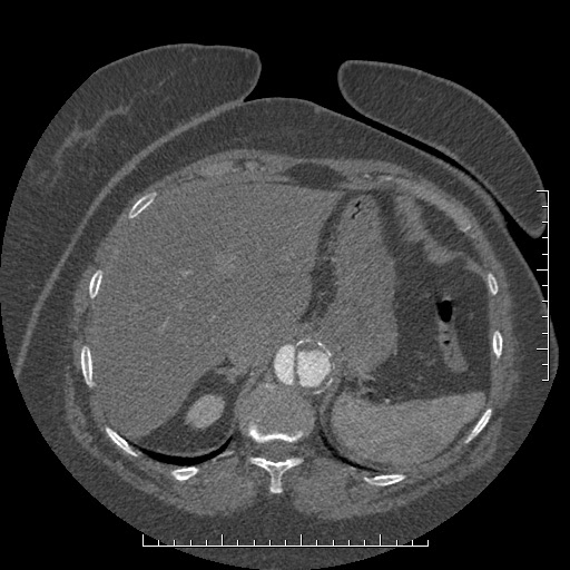 File:Aortic dissection- Stanford A (Radiopaedia 35729-37268 B 27).jpg