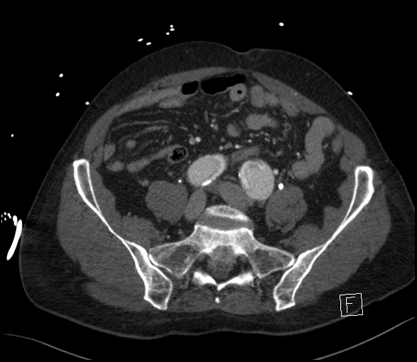 Aortic dissection (CTPA) (Radiopaedia 75506-86750 E 107).jpg