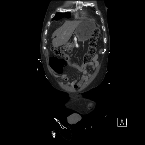 Aortic dissection (CTPA) (Radiopaedia 75506-86750 F 9).jpg
