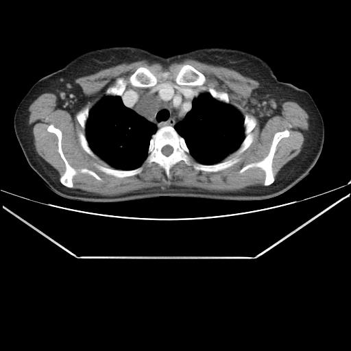 File:Aortic dissection (Radiopaedia 25350-25604 C 7).jpg