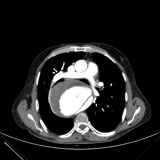 Aortic dissection (Radiopaedia 27466-27665 C+ arterial phase 111).jpg