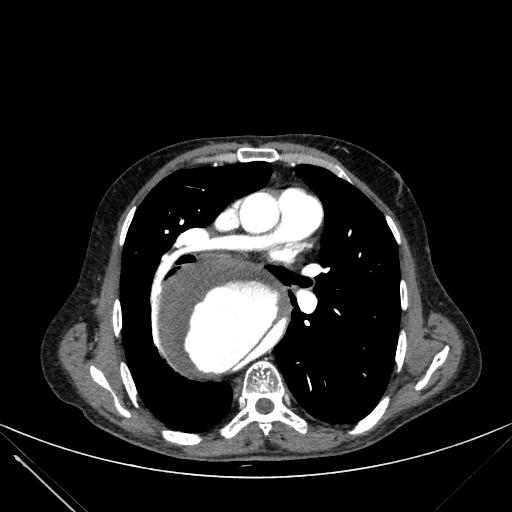 Aortic dissection (Radiopaedia 27466-27665 C+ arterial phase 122).jpg