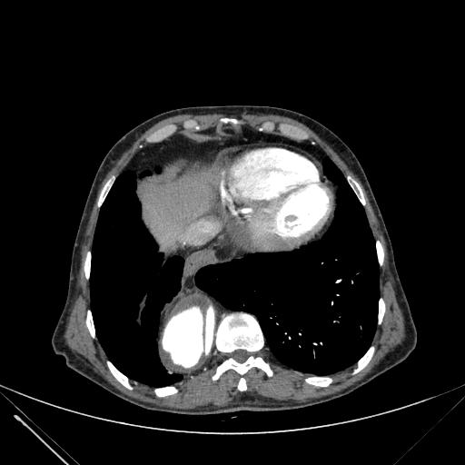 Aortic dissection (Radiopaedia 27466-27665 C+ arterial phase 228).jpg