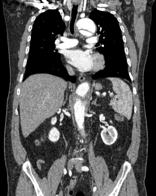 Aortic dissection (Radiopaedia 44411-48061 A 28).jpg