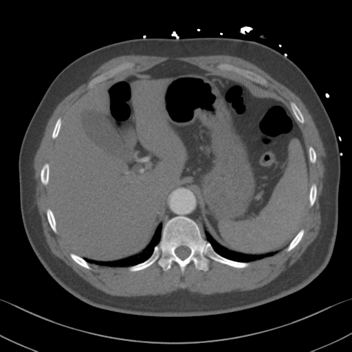 File:Aortic dissection (Radiopaedia 50763-56234 A 72).png