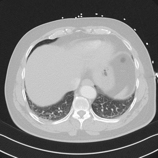 File:Aortic dissection (Radiopaedia 50763-56234 Axial lung window 51).png