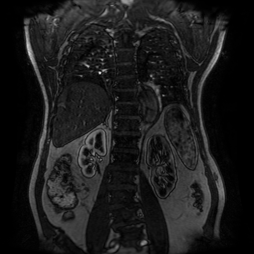 File:Aortic dissection - Stanford A - DeBakey I (Radiopaedia 23469-23551 D 177).jpg