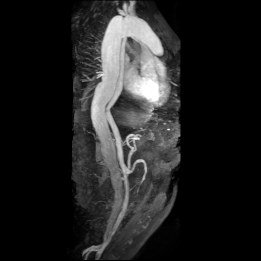 File:Aortic dissection - Stanford A - DeBakey I (Radiopaedia 23469-23551 MRA 8).jpg