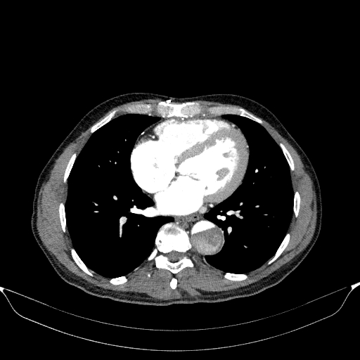 File:Aortic dissection - Stanford type A (Radiopaedia 83418-98500 A 41).jpg