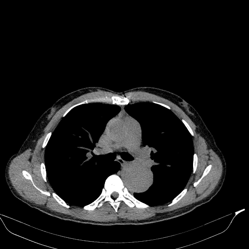 Aortic dissection - Stanford type A (Radiopaedia 83418-98500 Axial non-contrast 18).jpg