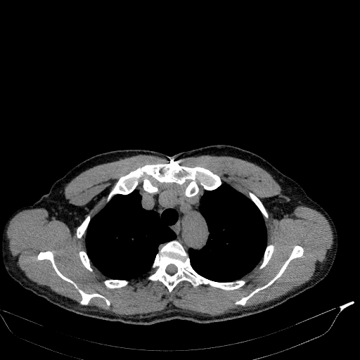 Aortic dissection - Stanford type A (Radiopaedia 83418-98500 Axial non-contrast 8).jpg