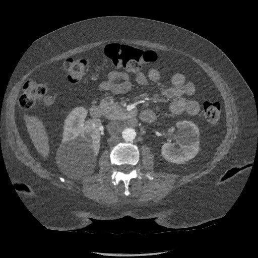File:Aortic dissection - Stanford type B (Radiopaedia 88281-104910 A 118).jpg