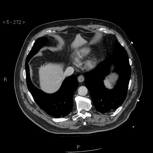 Aortic intramural hematoma (Radiopaedia 48463-53380 C 122).jpg