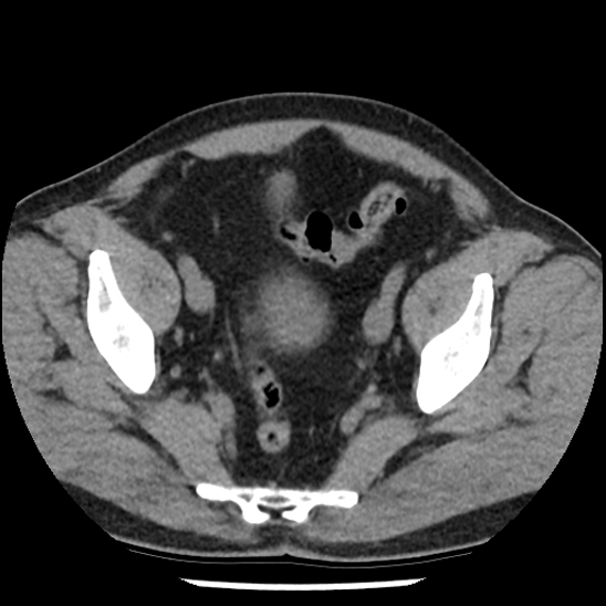 Aortic intramural hematoma (type B) (Radiopaedia 79323-92387 Axial non-contrast 102).jpg
