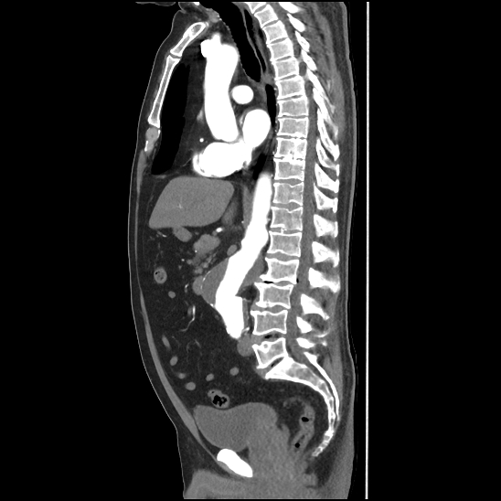 Aortic intramural hematoma (type B) (Radiopaedia 79323-92387 H 25).jpg