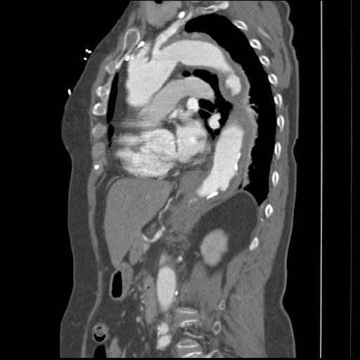 File:Aortic intramural hematoma from penetrating atherosclerotic ulcer (Radiopaedia 31137-31836 B 14).jpg
