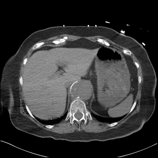 File:Aortic intramural hematoma with dissection and intramural blood pool (Radiopaedia 77373-89491 Axial non-contrast 91).jpg