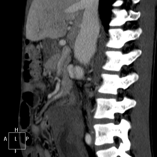 Aorto-left renal vein fistula (Radiopaedia 45534-49628 C 25).jpg
