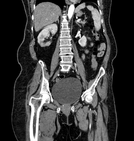 Aortoiliac occlusive disease (Radiopaedia 52352-58248 B 33).jpg