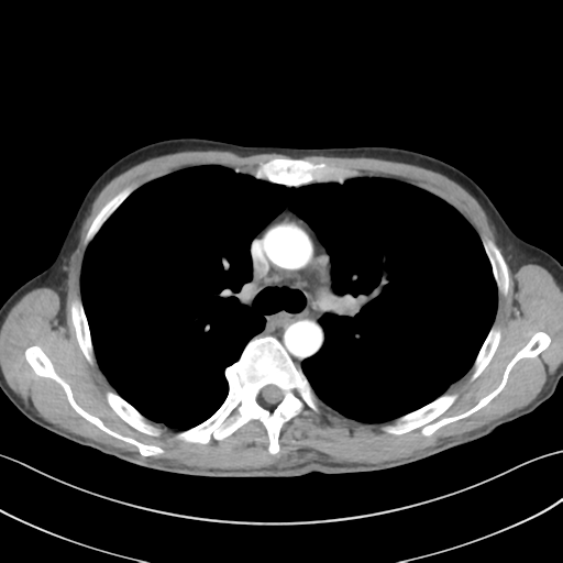 File:Apical pleural calcification (Radiopaedia 46141-50499 Axial C+ delayed 25).png