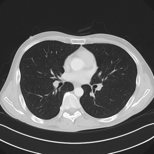 Apical pleural calcification (Radiopaedia 46141-50499 Axial lung window 35).png