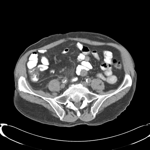 Appendiceal abscesses (Radiopaedia 50999-56542 Axial non-contrast 55).png