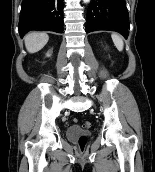 Appendiceal adenocarcinoma complicated by retroperitoneal abscess (Radiopaedia 58007-65039 A 62).jpg