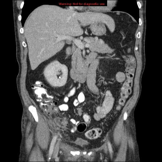 File:Appendicitis mass in inguinal hernia (Radiopaedia 26858-27029 B 29).jpg