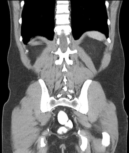 Appendicitis with cecal bar sign (Radiopaedia 31878-32830 A 48).jpg