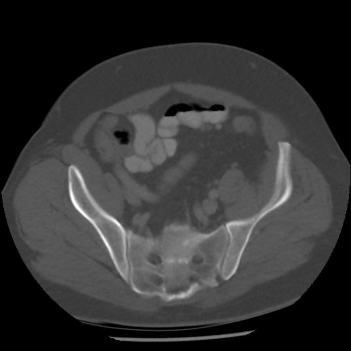 Appendicitis with perforation (Radiopaedia 35790-37342 Axial bone window 42).jpg