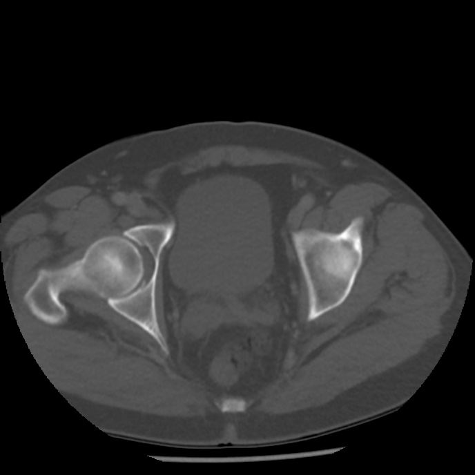 Appendicitis with perforation (Radiopaedia 35790-37342 Axial bone window 49).jpg