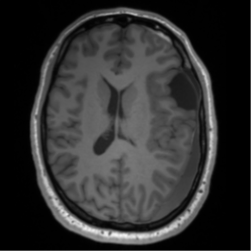 File:Arachnoid cyst with subdural hematoma (Radiopaedia 85892-101743 Axial T1 53).png
