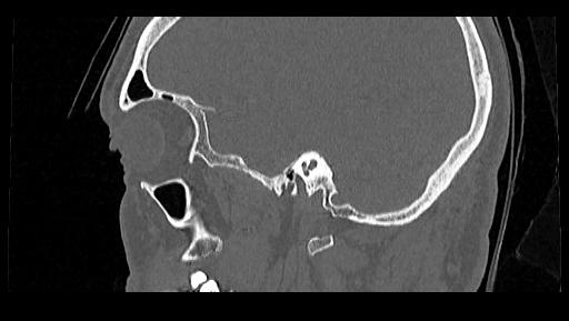 Arcuate foramen (Radiopaedia 89833-106944 Sagittal bone window 119).jpg