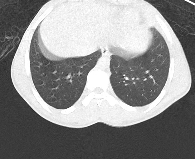 File:Arrow injury to the chest (Radiopaedia 75223-86321 Axial lung window 75).jpg