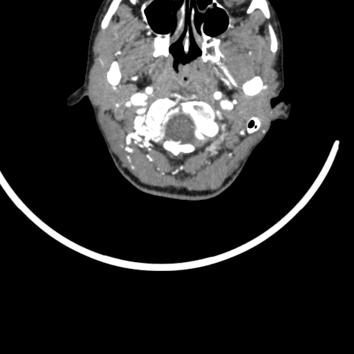 Arteriovenous malformation of the neck (Radiopaedia 53935-60062 A 62).jpg